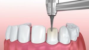 dental crowns and veneers Yuma AZ