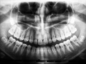 X-ray showing impacted wisdom teeth