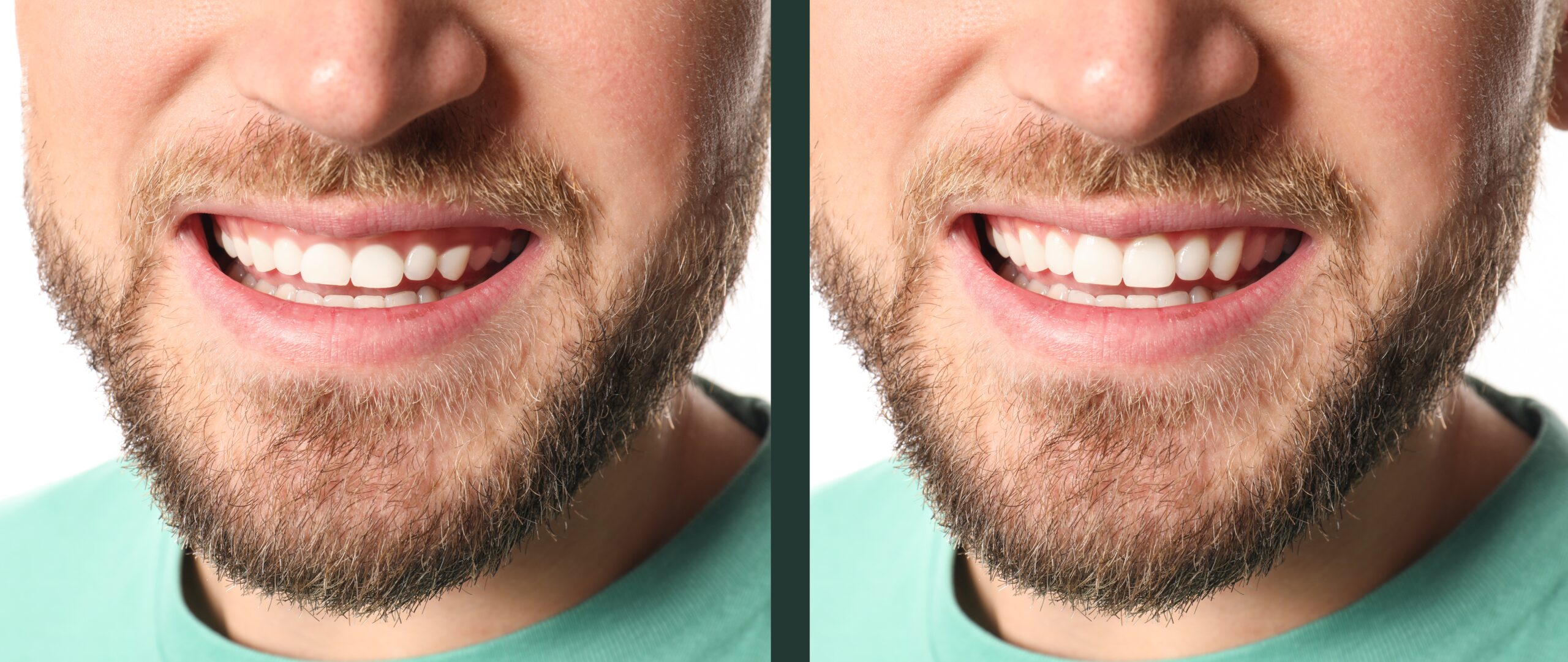 side by side of gummy smile, fixed by laser dentistry